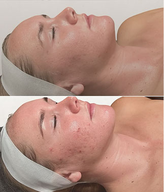 2 weeks progress Skin treatments